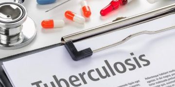 Waspadai Potensi Penularan TBC melalui Droplet